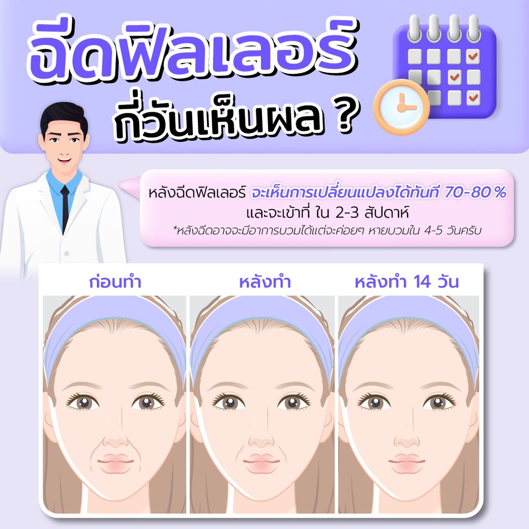 ฉีดฟิลเลอร์ Belotero Revive กี่วันเห็นผล